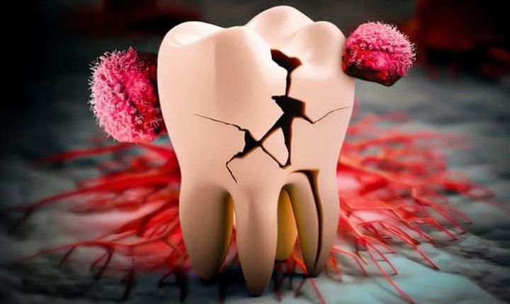 محققان آمریکایی: مسواک نزدن با افزایش خطر ابتلا به سرطان سر و گردن مرتبط است